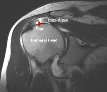 Rotator Cuff Tear