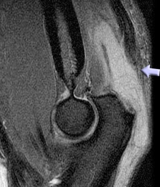 Triceps Tendon Tears