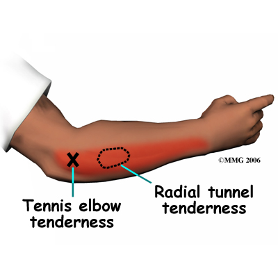 Radial Tunnel Syndrome