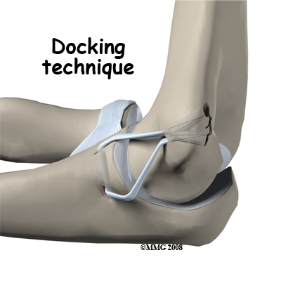 UCL Reconstruction