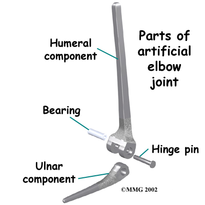Artificial Joint Replacement of the Elbow