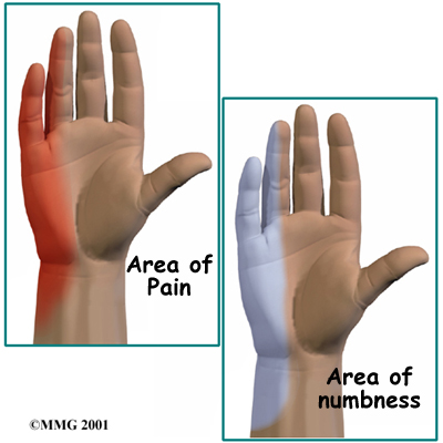 Cubital Tunnel Syndrome