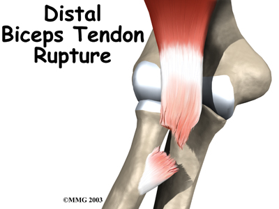 Distal Biceps Repair