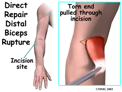 Distal Biceps Repair