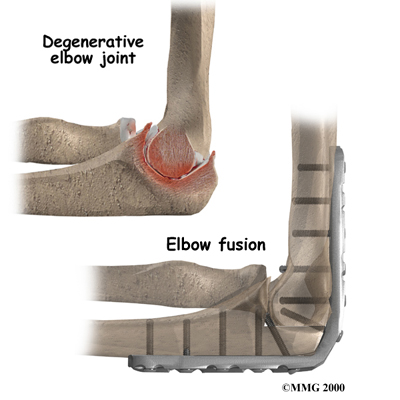 Elbow Fusion