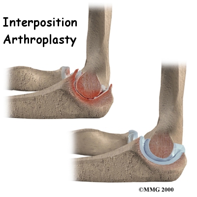Interposition Arthroplasty of the Elbow