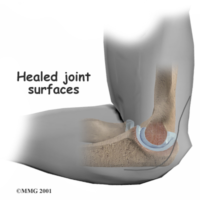 Interposition Arthroplasty of the Elbow