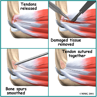 Tendon Debridement