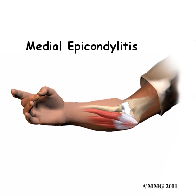 Elbow Fractures