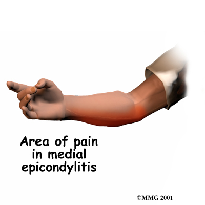 Elbow Fractures