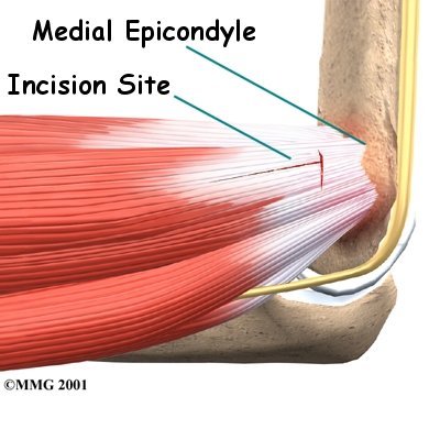 Elbow Fractures