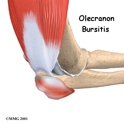 Elbow Bursitis