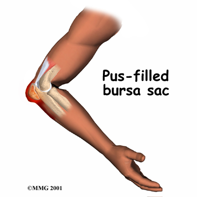 Elbow Bursitis