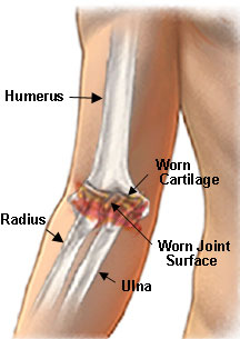 Elbow Arthritis