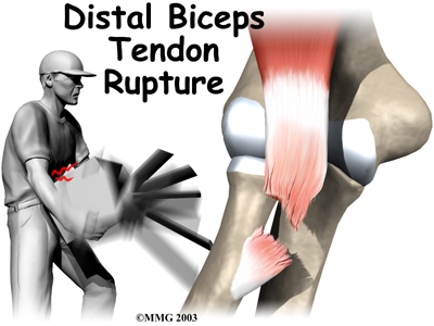 Bicep Tendon Tear at the Elbow
