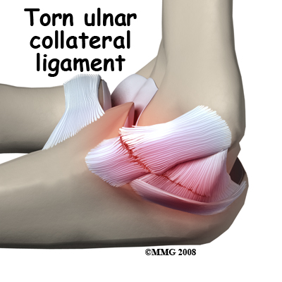 Ulnar Collateral Ligament Injuries