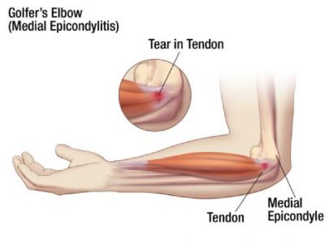 Elbow Fractures