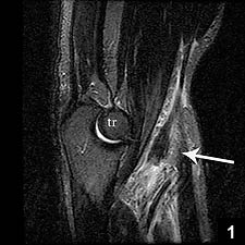 Bicep Tendon Tear at the Elbow