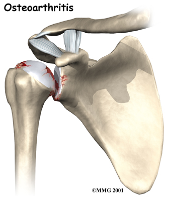 Reverse Shoulder Arthroplasty