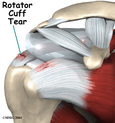 Reverse Shoulder Arthroplasty