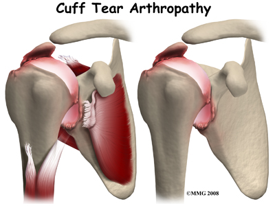 Reverse Shoulder Arthroplasty