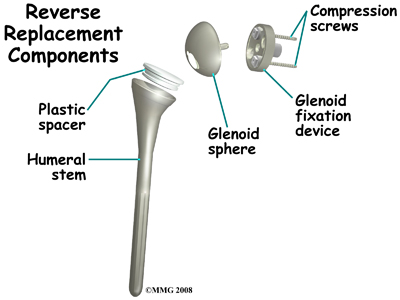 Reverse Shoulder Arthroplasty