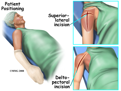 Reverse Shoulder Arthroplasty