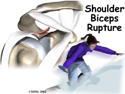 Bicep Tendon Rupture at Shoulder