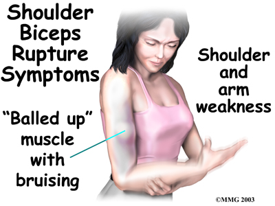 Bicep Tendon Rupture at Shoulder