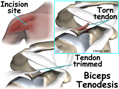 Bicep Tendon Rupture at Shoulder