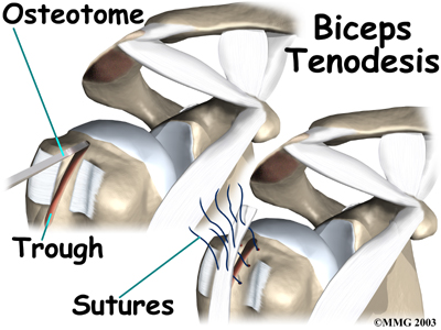 Bicep Tendon Rupture at Shoulder