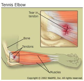 Tennis Elbow/Lateral Epicondylitis