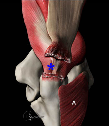 Triceps Tendon Tears