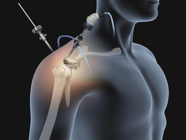 Minimally Invasive Surgical Techniques for the Shoulder & Elbow